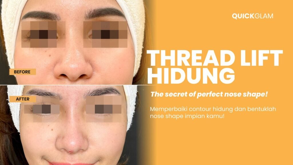 Threadlift hidung adalah prosedur kosmetik non-bedah yang semakin populer untuk memperbaiki bentuk dan penampilan hidung.